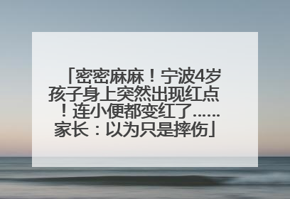 密密麻麻！宁波4岁孩子身上突然出现红点！连小便都变红了……家长：以为只是摔伤